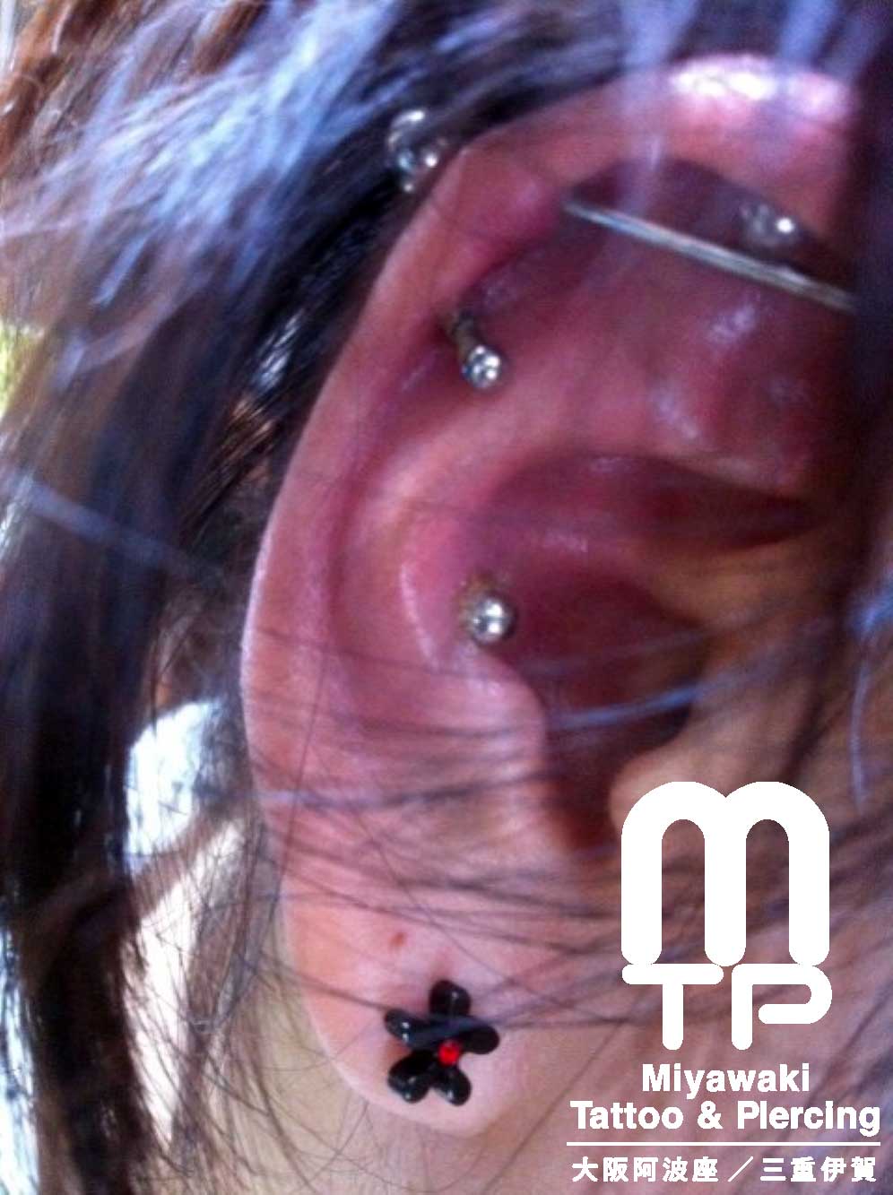 右耳のインナーコンク（コンク）ピアスが赤く腫れた状態。