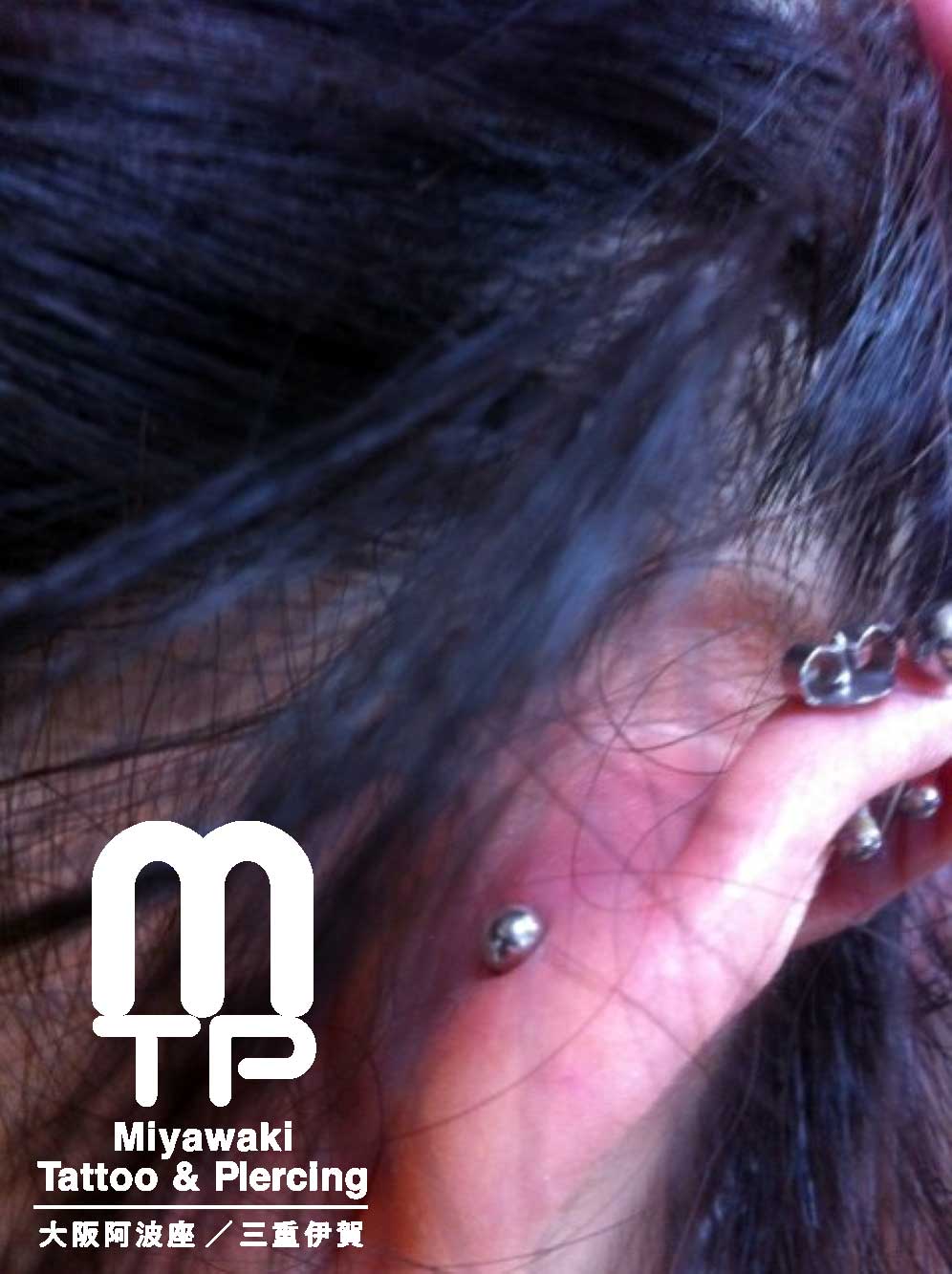 右耳のインナーコンク（コンク）ピアスが赤く腫れた裏側の状態。