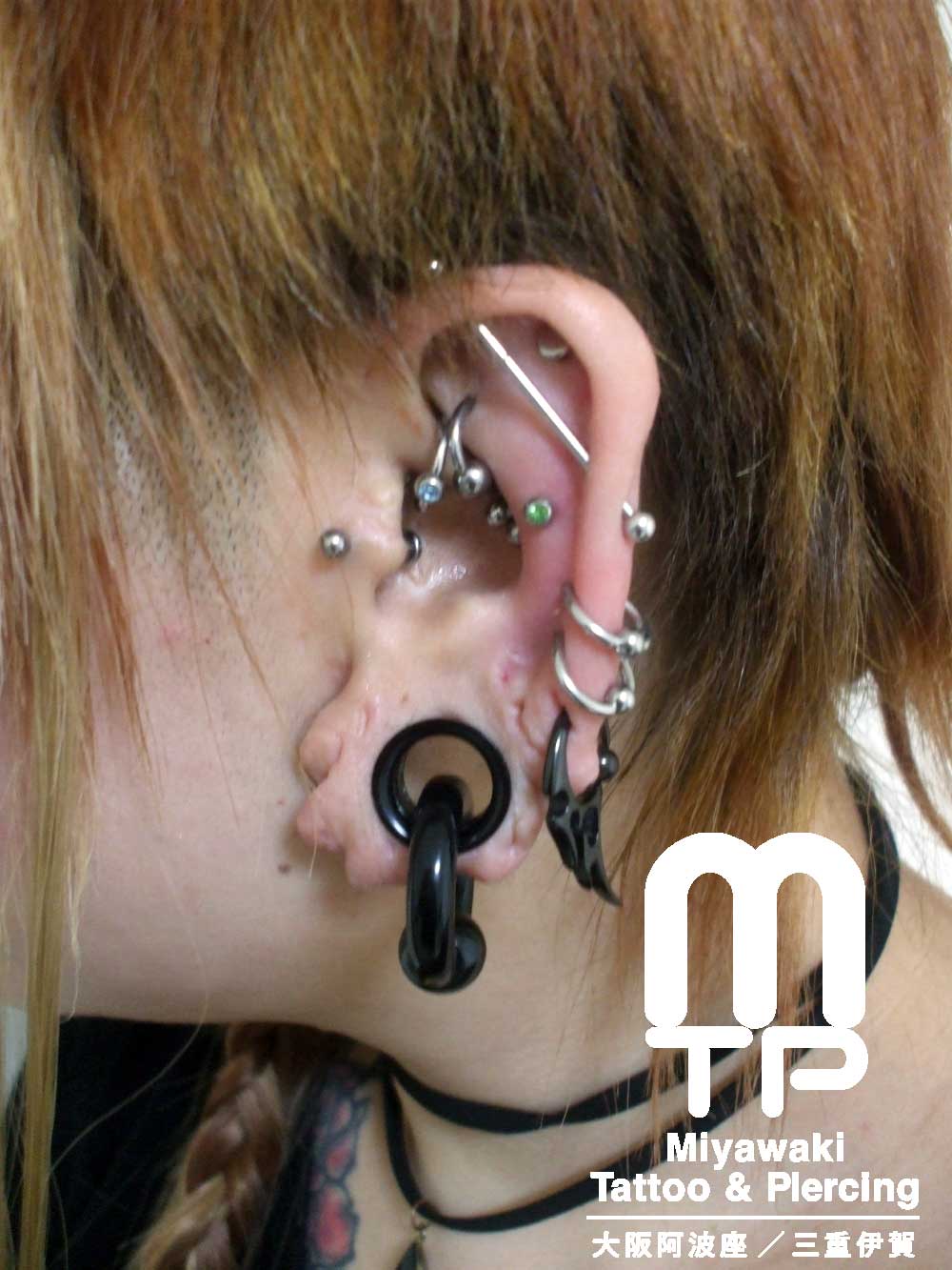 複数個の左耳たぶのピアスが排出、排除した後の耳たぶの形状。