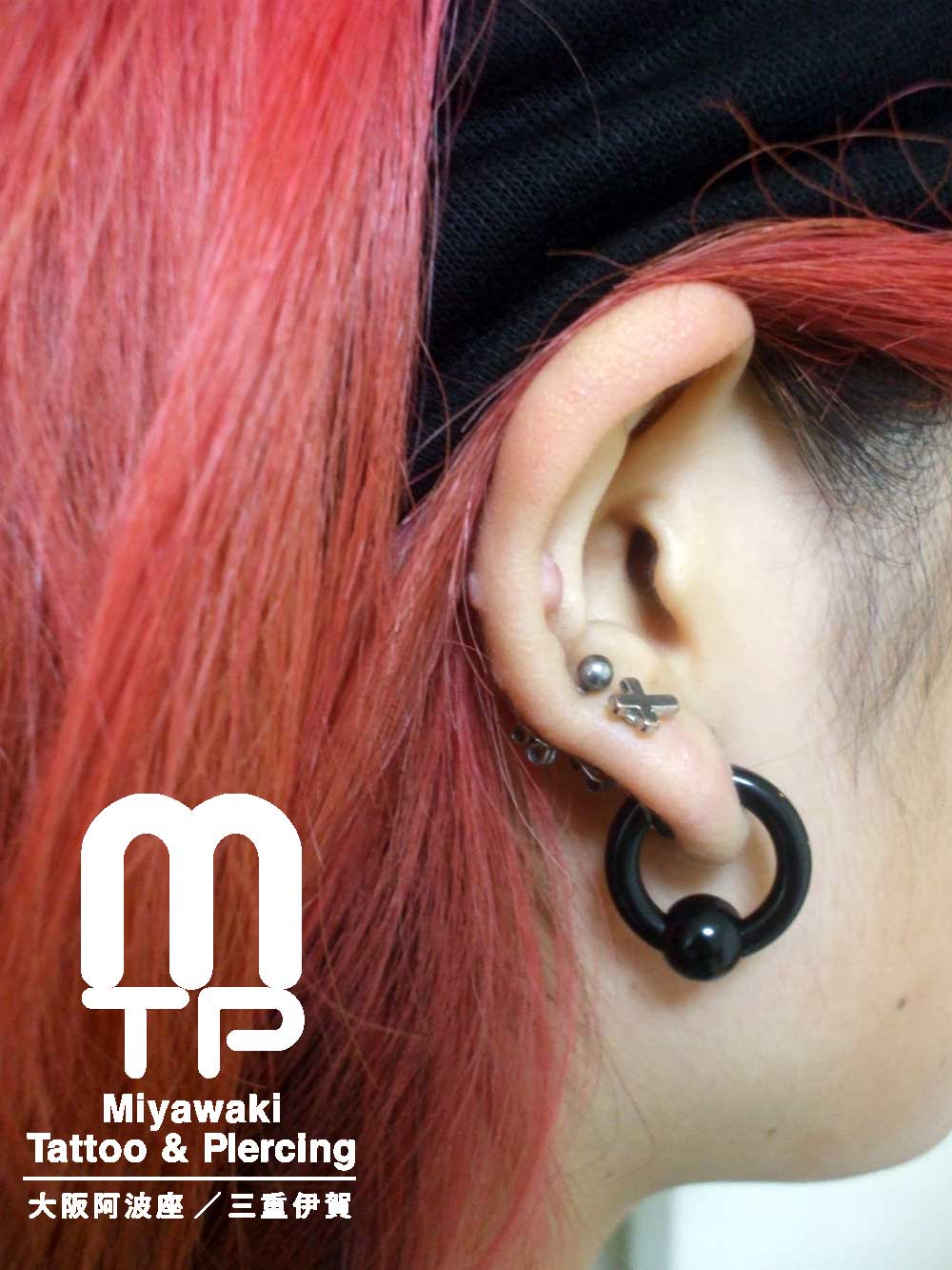 右耳のヘリックスピアスの肉芽。