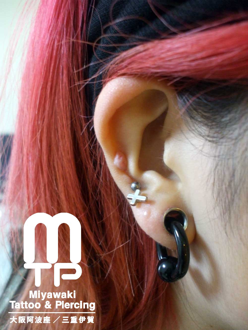 右耳のヘリックスピアスの肉芽。