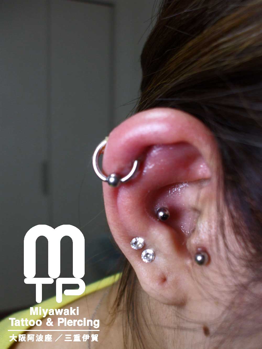 右耳のリングジュエリーでのヘリックスの化膿。