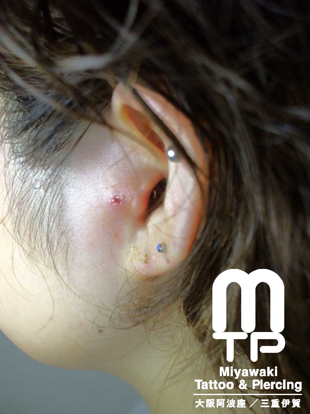 左耳のトラガスピアスが腫れて耳外側のキャッチが埋まった状態。