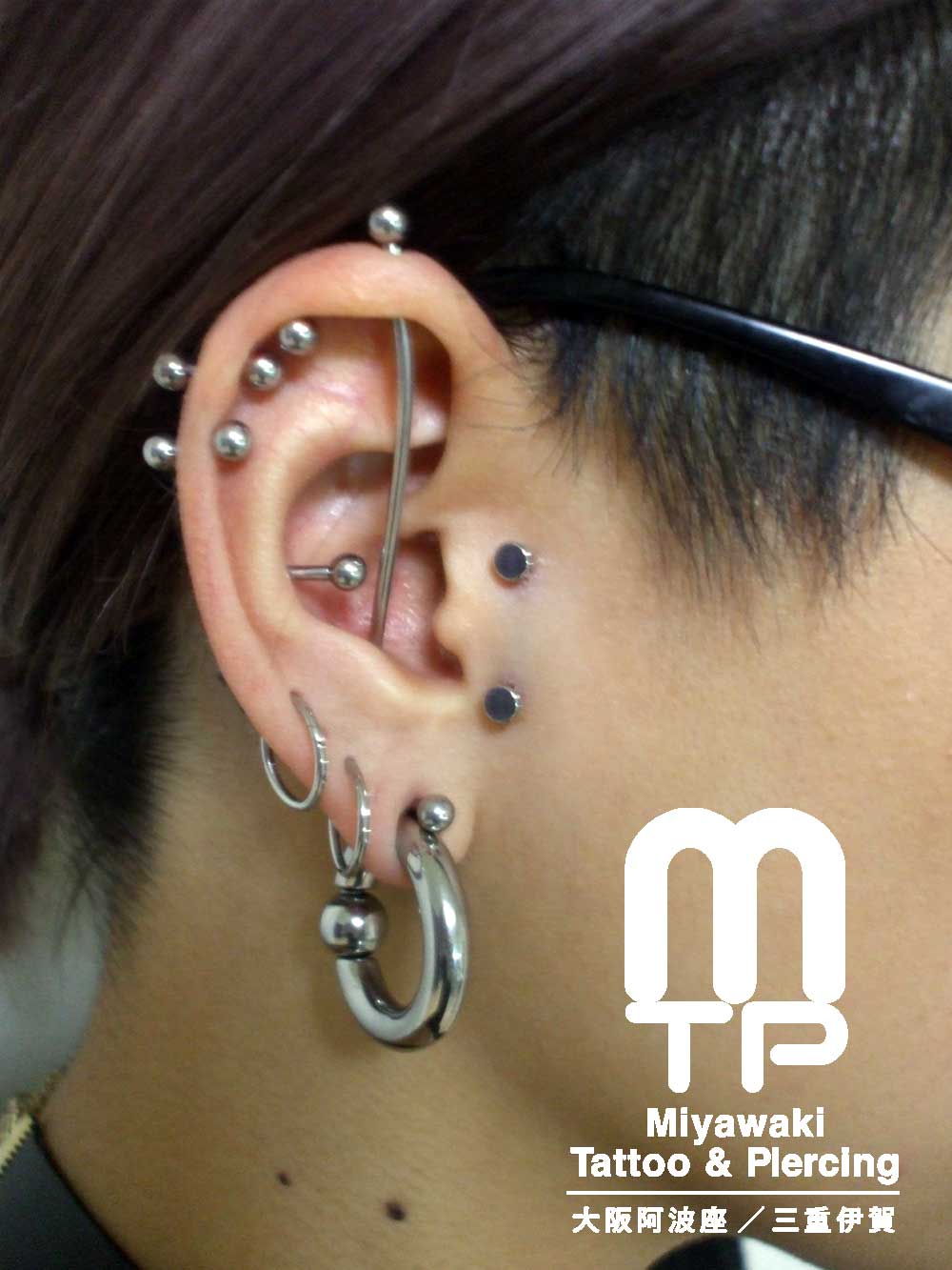 右耳へサーフェイスピアッシングジュエリーによるヴァーティカルトラガスの排除。