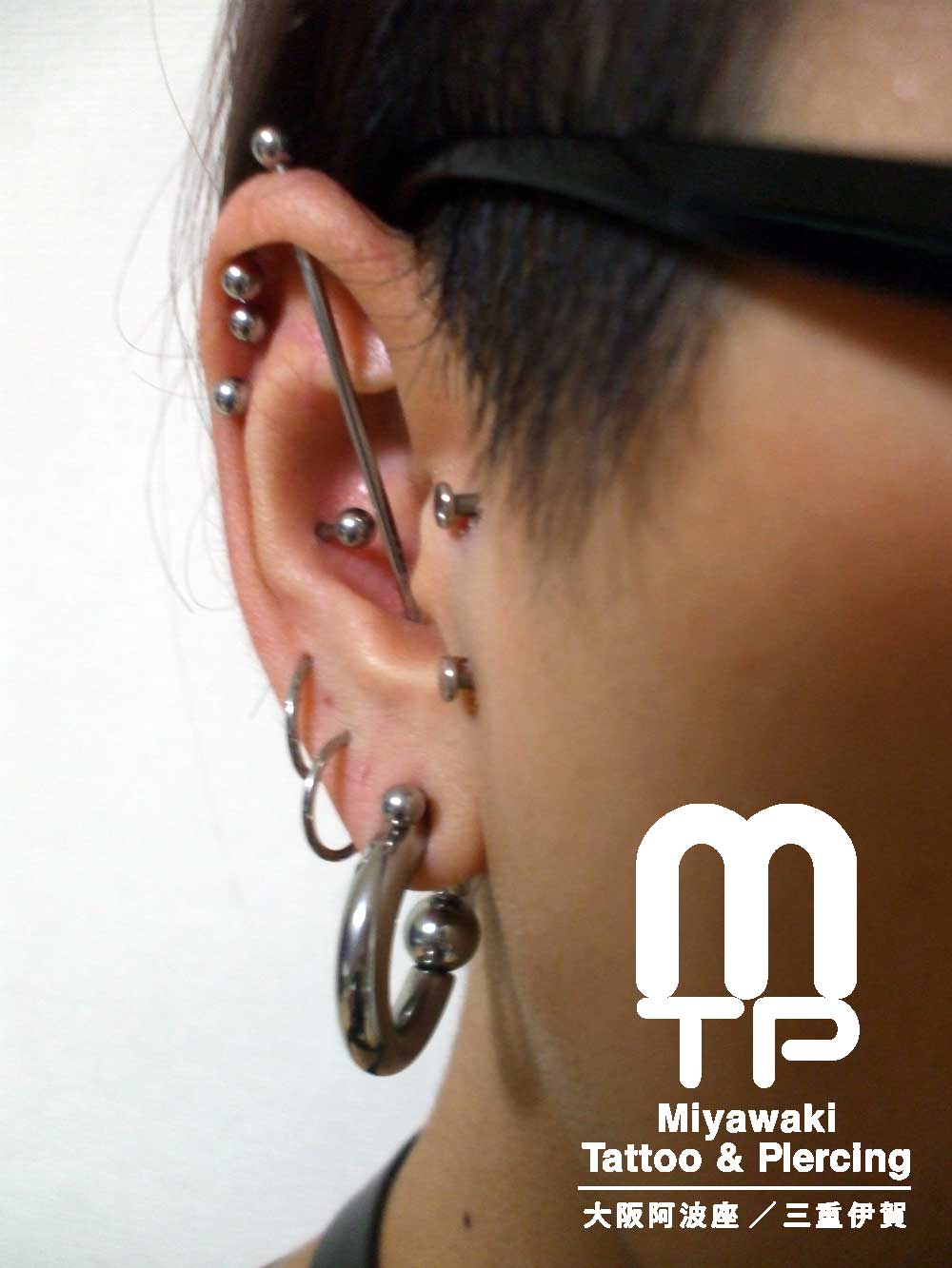右耳へサーフェイスピアッシングジュエリーによるヴァーティカルトラガスの排除。