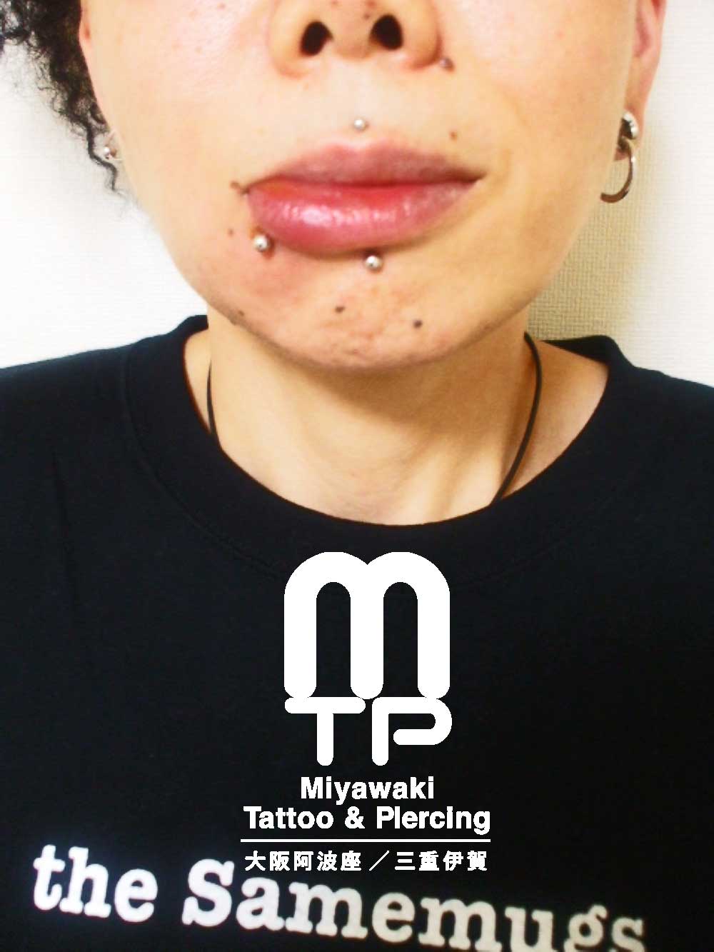 部位及び名称　右リップピアスの腫れ