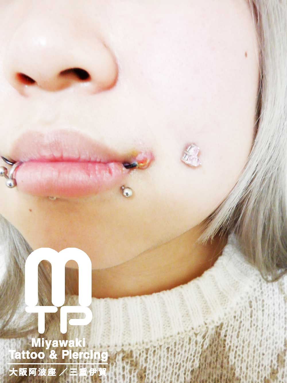 部位及び名称　左唇口角付近のピアスの排除及び肉芽