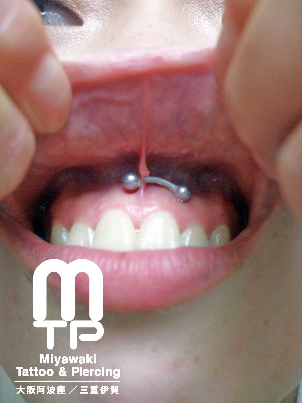 ピアスホールのトラブルの症状：スクランパーの上唇小帯が排除、排出の為に裂ける