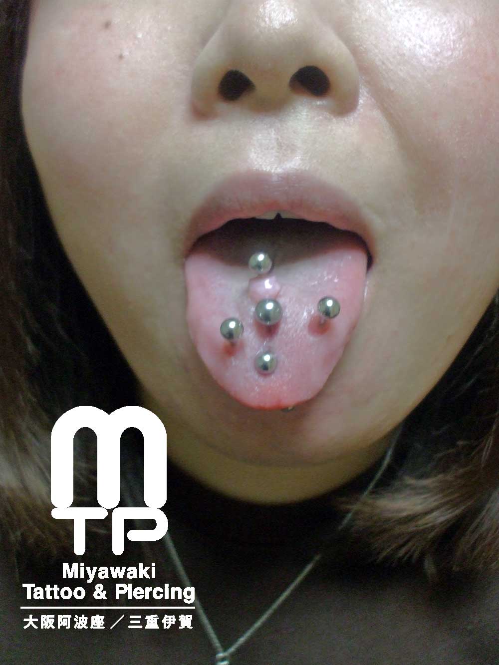 舌ピアスのトラブルの症状：複数個で開けた舌ピアスの舌先側に出来た肉芽