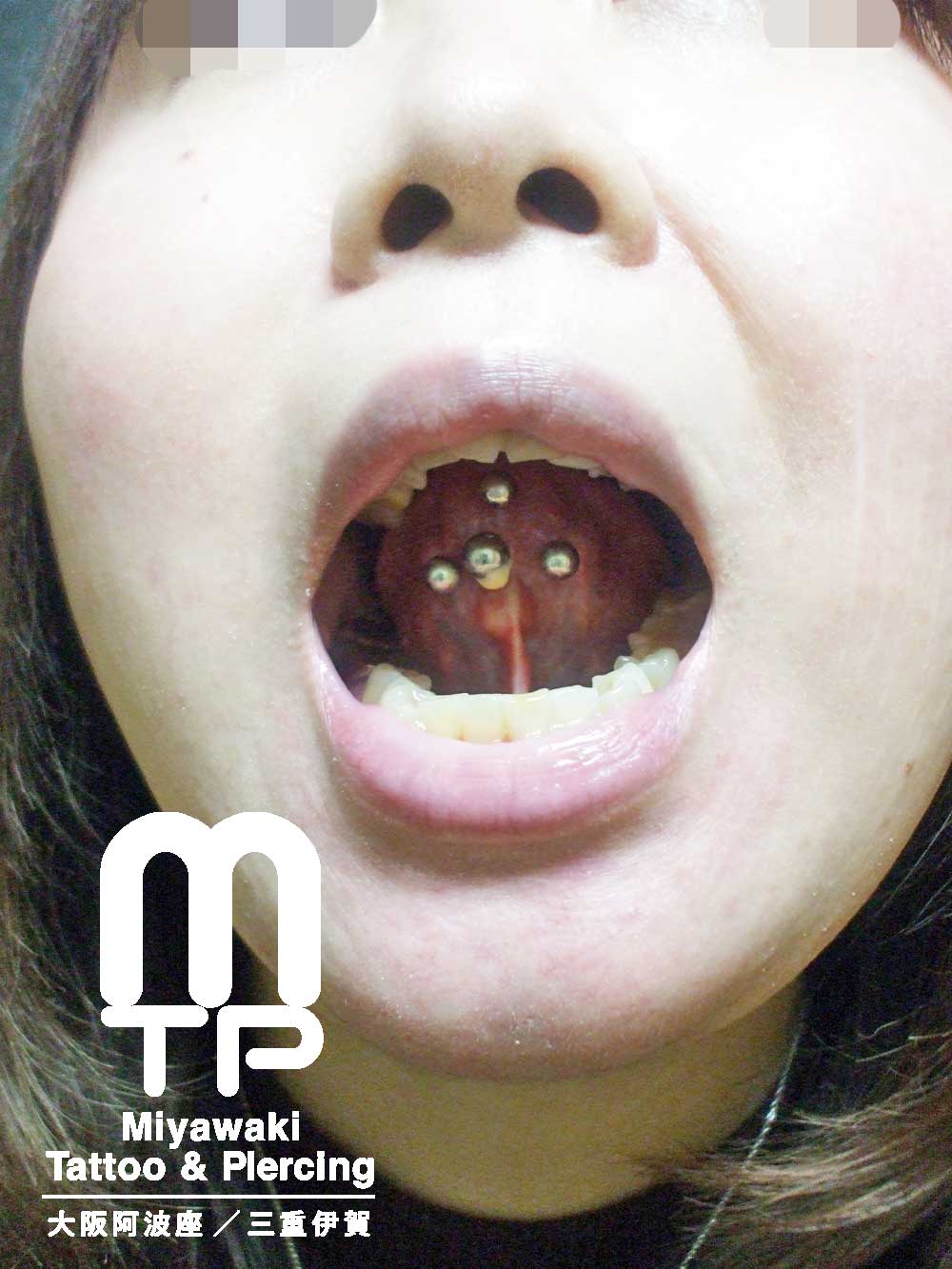 舌ピアスのトラブルの症状：複数個で開けた舌ピアスの舌先側に出来た肉芽（舌裏側）