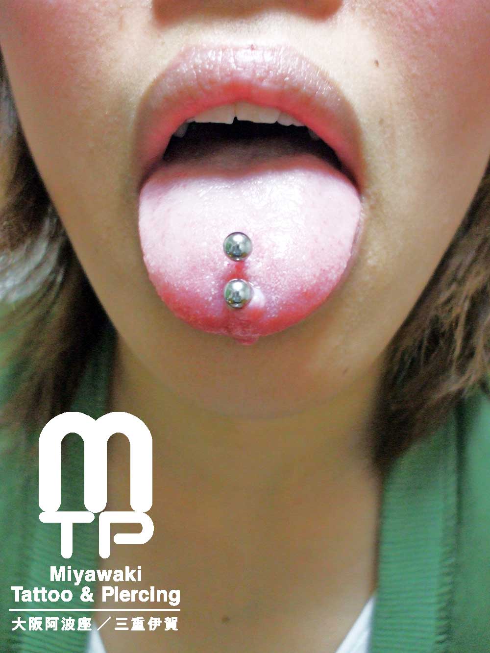 舌ピアスのトラブルの症状：２連で開けた舌ピアスの舌先側に出来た肉芽