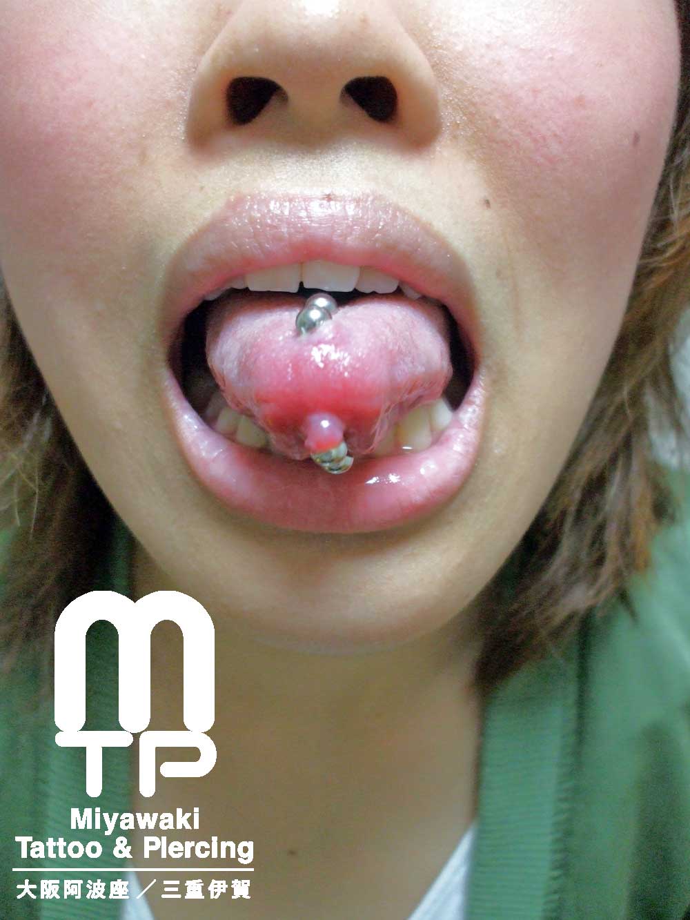 舌ピアスのトラブルの症状：２連で開けた舌ピアスの舌先側に出来た肉芽（舌裏側）