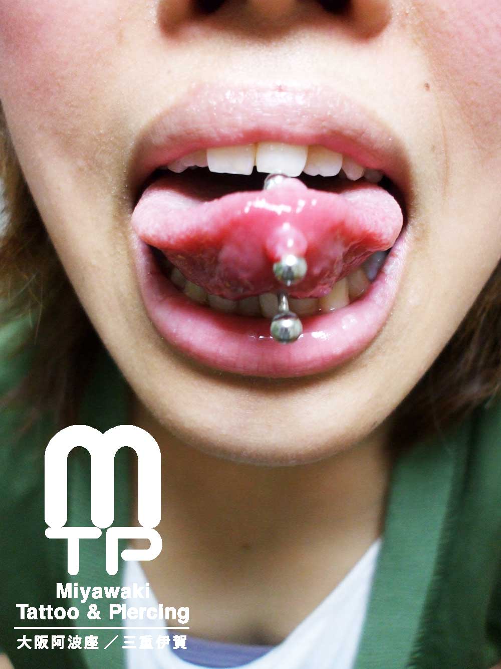 舌ピアスのトラブルの症状：２連で開けた舌ピアスの舌先側に出来た肉芽（舌裏側）