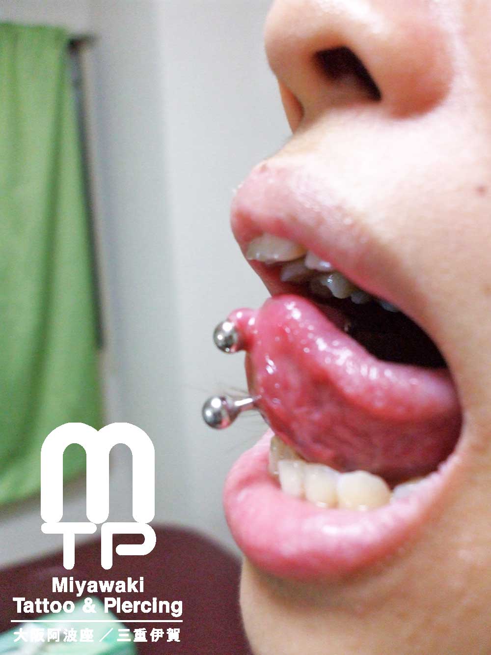 舌ピアスのトラブルの症状：２連で開けた舌ピアスの舌先側に出来た肉芽（舌裏側）を横から見た状態