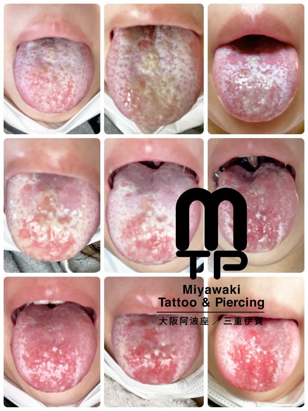 舌ピアスのピアスホールのトラブルと症状：舌ピアス（センタータンの）化膿の症状から改善までその２