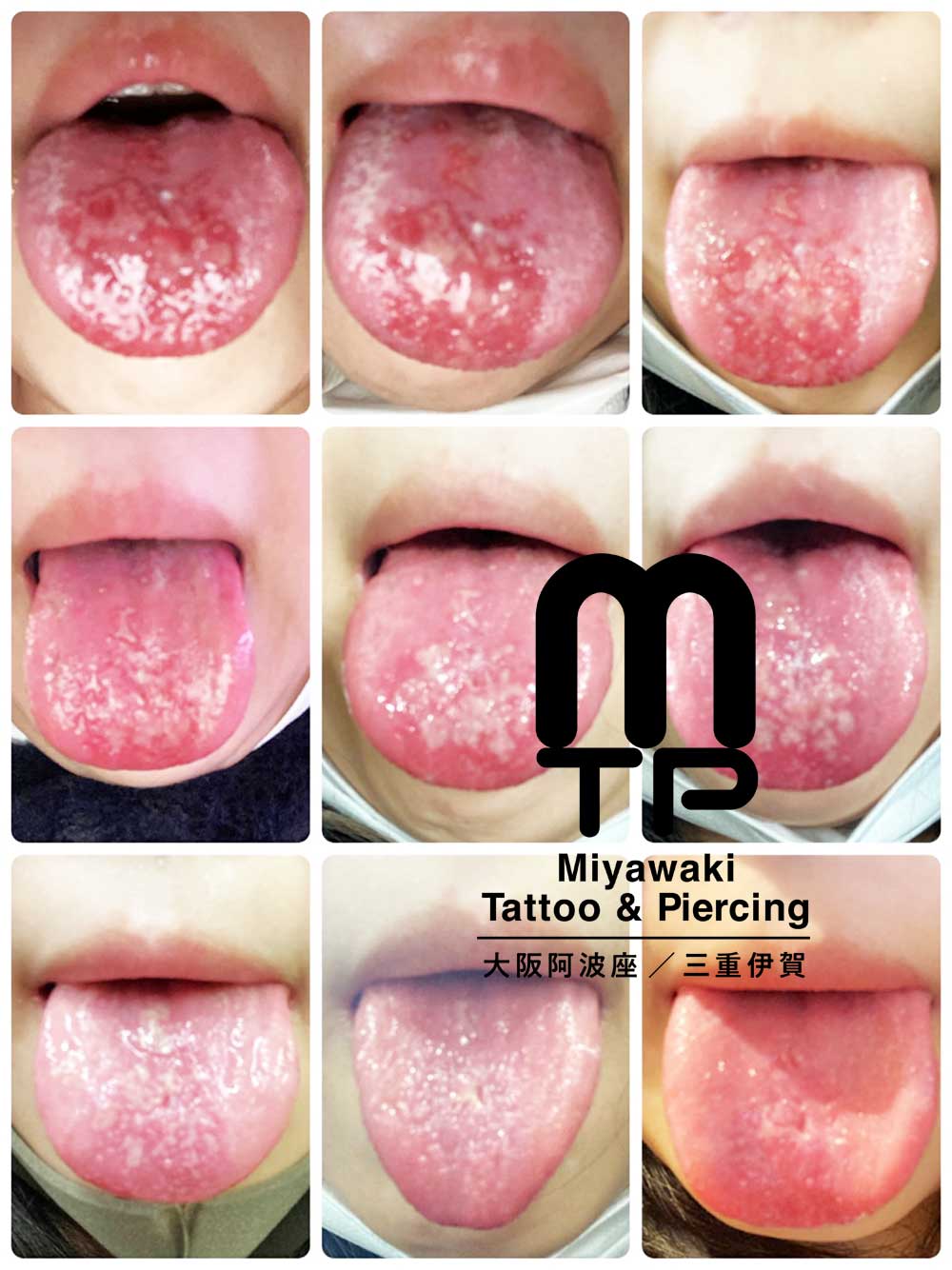 舌ピアスのピアスホールのトラブルと症状：舌ピアス（センタータンの）化膿の症状から改善までその３