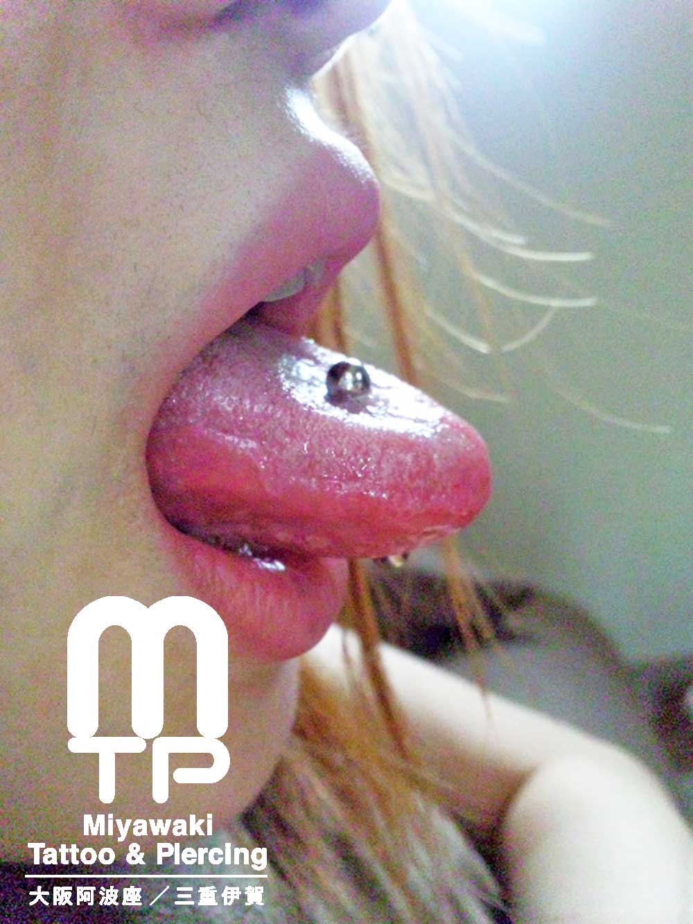 舌ピアスの施術後からの腫れの経過：舌へのピアッシング３日後の腫れ