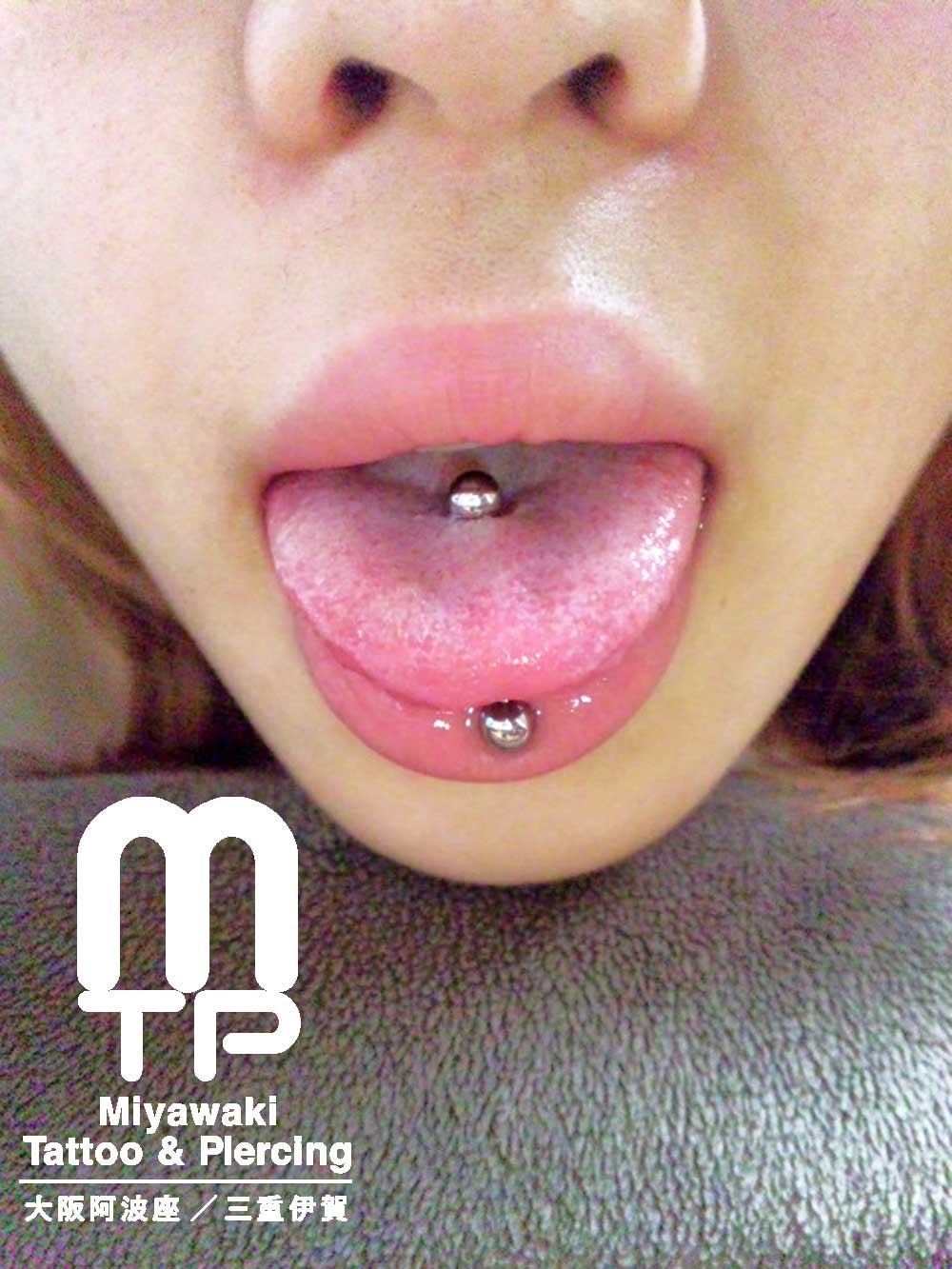 舌ピアスの施術後からの腫れの経過：舌へのピアッシング４日後の腫れ