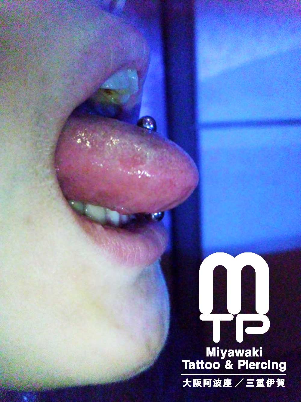 舌へ舌ピアスの施術後からの腫れの経過：舌へのピアッシング当日の腫れ