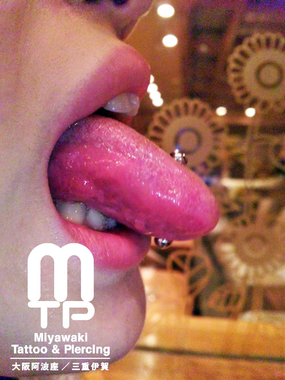 舌ピアスの施術後からの腫れの経過：舌へのピアッシング１日後の腫れ