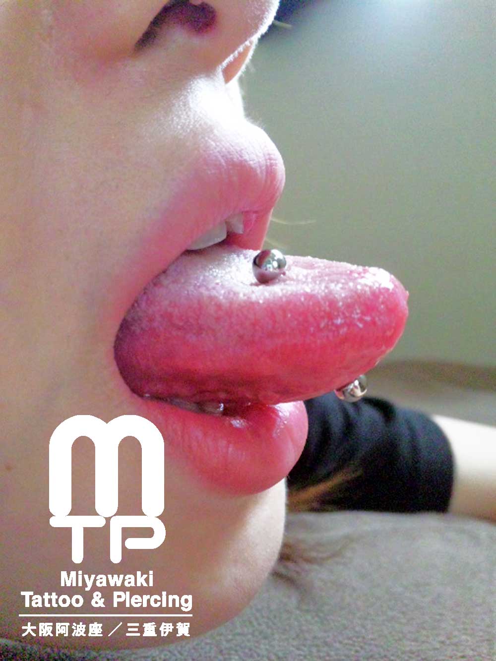 舌ピアスの施術後からの腫れの経過：舌へのピアッシング２日後の腫れ