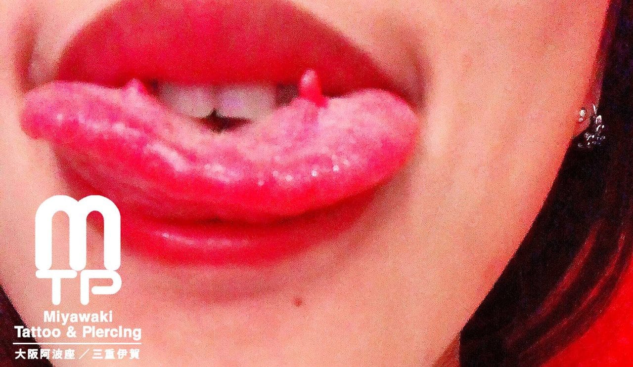 舌ピアスのトラブルの症状：左右に開けた舌ピアスのタンリムに出来た肉芽（舌上部）