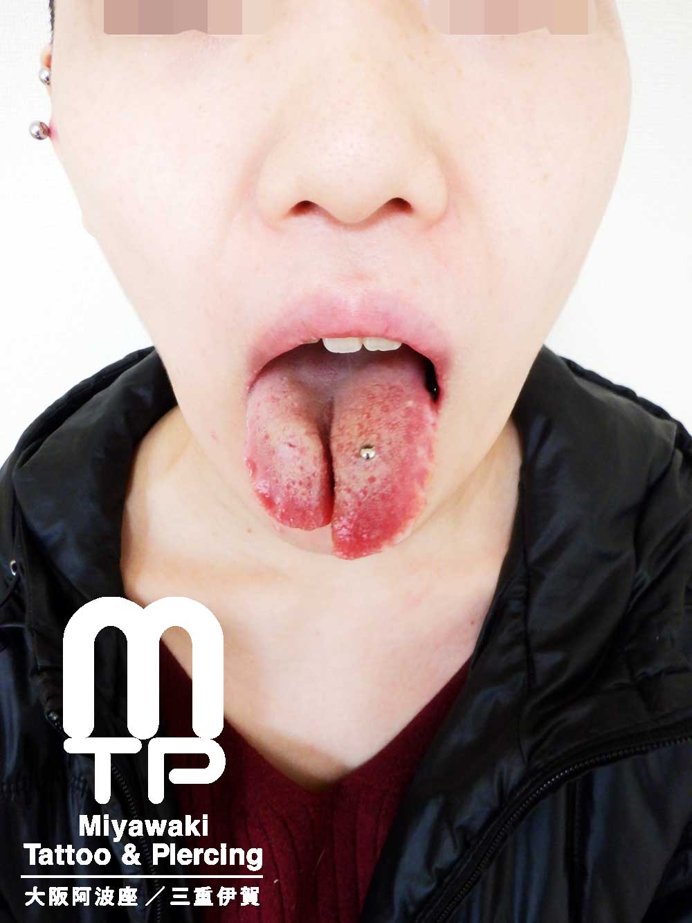 舌のピアスホールのトラブルの症状：腫れ