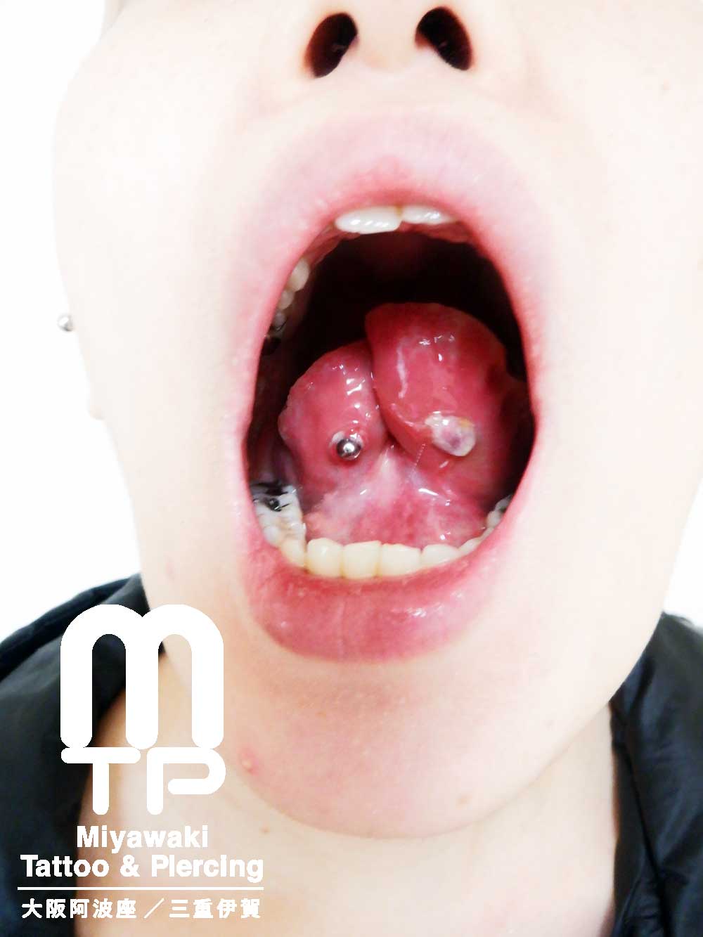 舌のピアスホールのトラブルの症状：腫れ