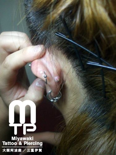 左耳のインナーコンクのピアスの耳裏側の肉芽。