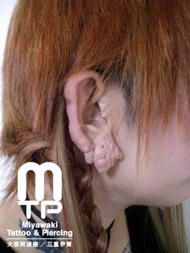 複数個の右耳たぶのピアスが排出、排除した後の耳たぶの形状。