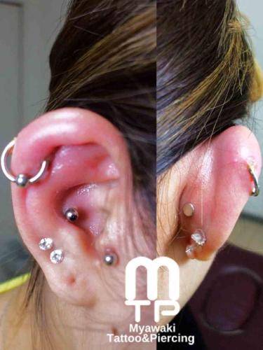 ヘリックスが化膿して激しい痛みと共に腫れあがった状態