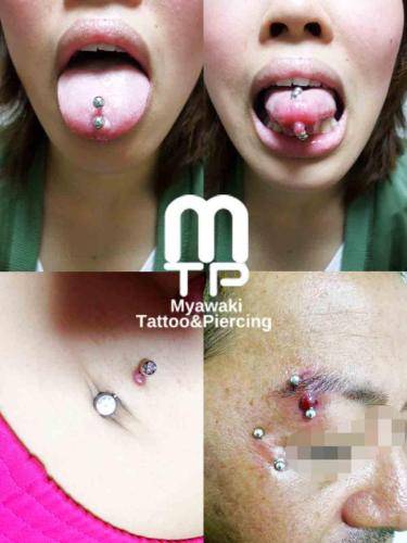 舌やおへそ、アイブロー等、様々な部位に出来る肉芽