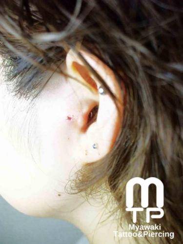 トラガスの腫れによるピアスジュエリーの埋没