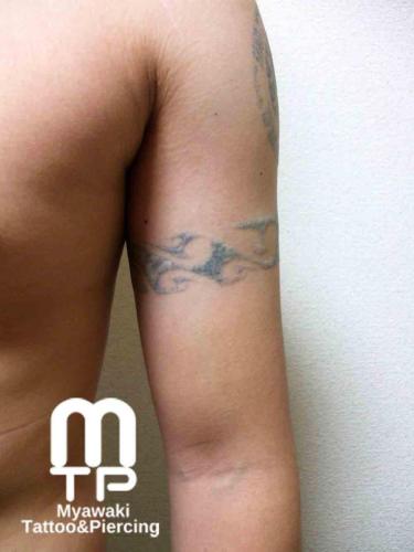 腕のタトゥー除去の跡４