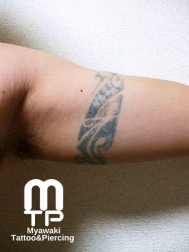 腕のタトゥー除去の跡２